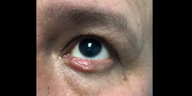 Características del carcinoma basocelular del párpado - Characteristics of eyelid basal cell carcinoma