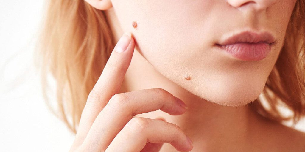 ¿Cuándo se debe eliminar un lunar en la cara? - Facial moles and when to remove them