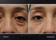 Recuperación después de una Blefaroplastia Inferior