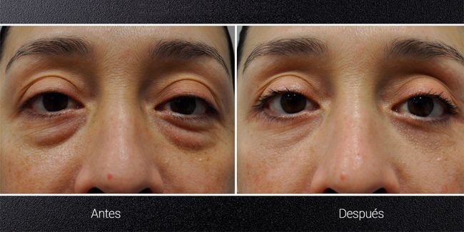 Recuperación después de una Blefaroplastia Inferior
