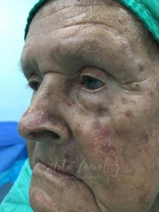 Cicatricial ectropion