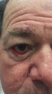 Ectropión Senil - Ectropión involutivo o senil