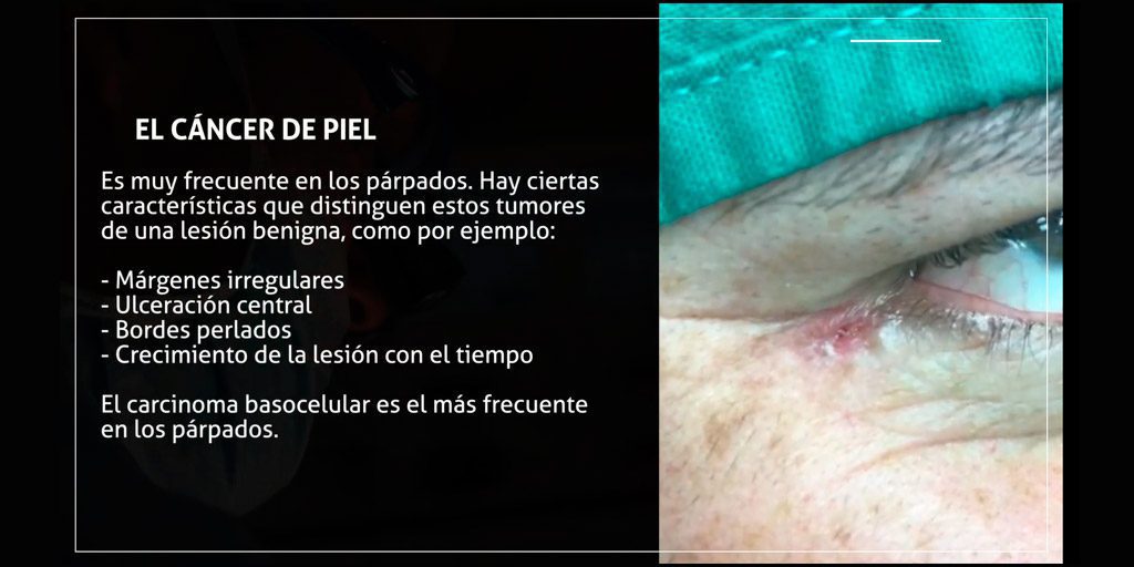 cancer-de-piel-parpados