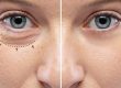 What is the best option to treat bags under my eyes, surgery or fillers