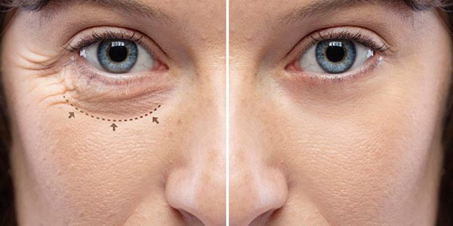 What is the best option to treat bags under my eyes, surgery or fillers