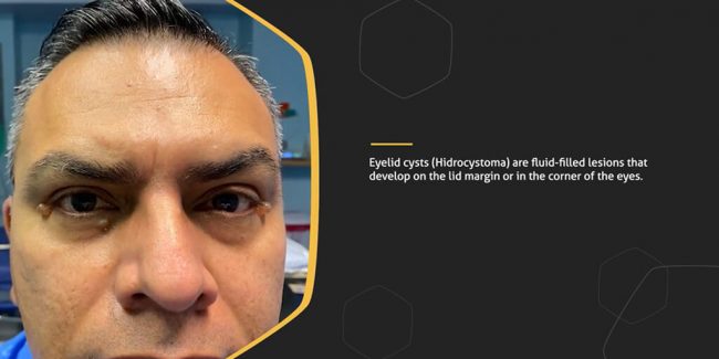 Eyelid cysts can be quite a nuisance - is there a good treatment