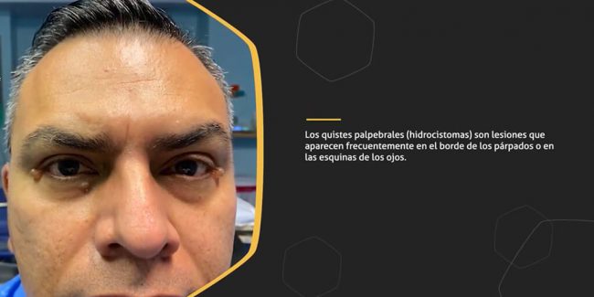 Los quistes en los párpados son una gran molestia - Será que existe un tratamiento