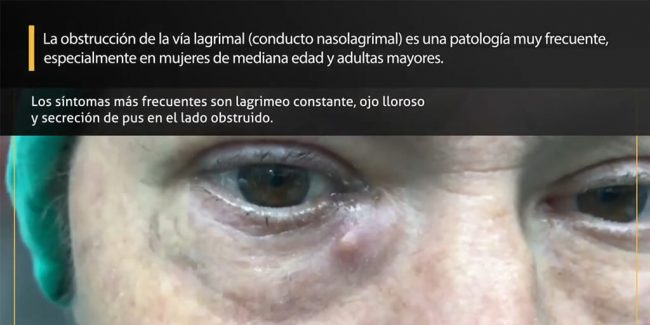La obstrucción de la vía lagrimal - diagnóstico y tratamiento
