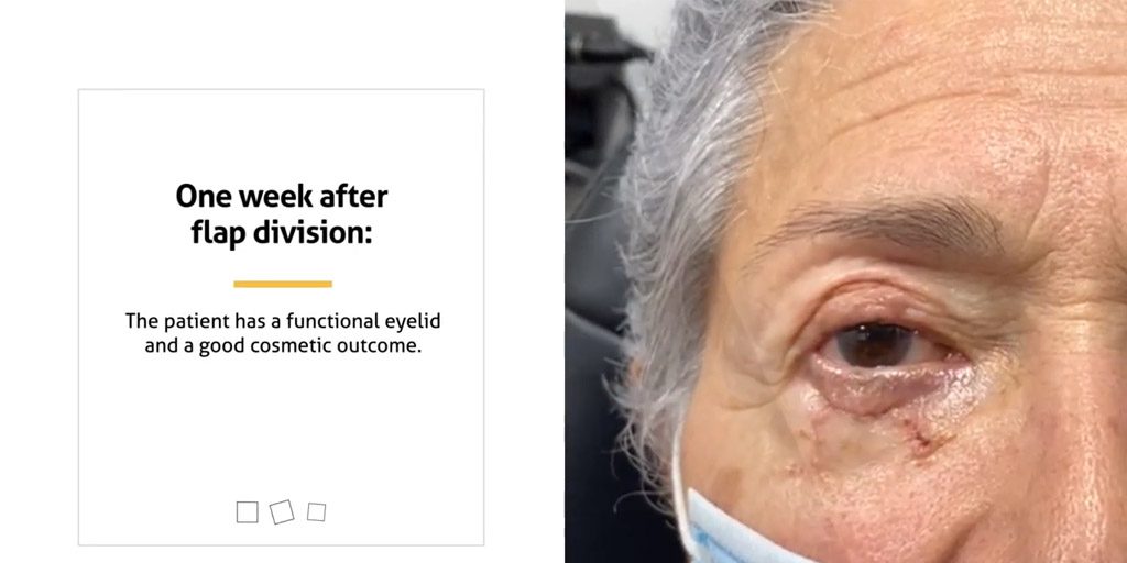 upper_eyelid-cancer_surgery