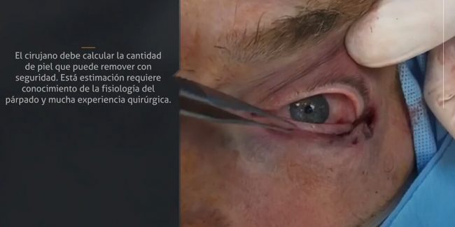 Cómo evitar complicaciones en la cirugía estética de los párpados inferiores