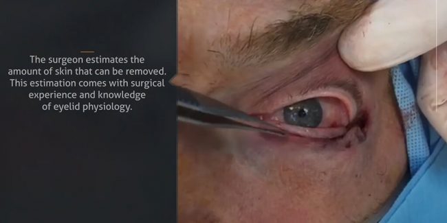 How to avoid complications in lower eyelid cosmetic surgery