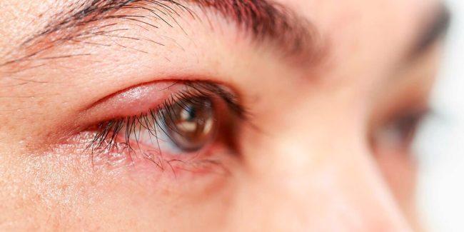 Disfunción de las Glándulas de Meibomio