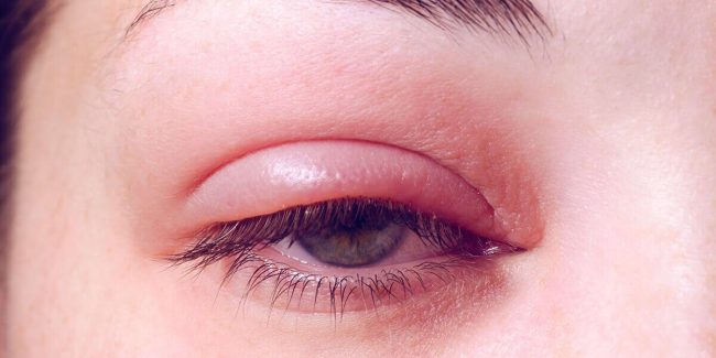 Stye and Chalazion
