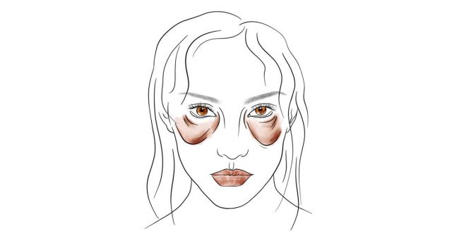 Treatment of festoons - Tratamiento de los festones malares