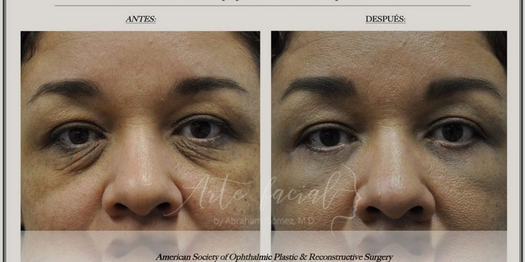 Before and after photos of eyelid plastic surgery Before and after photos of eyelid plastic surgery