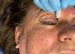 Blefaroplastia una cirugía para el levantamiento de párpados caídos