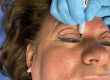 Blepharoplasty a surgery to lift droopy eyelids