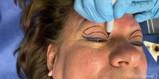 Blepharoplasty a surgery to lift droopy eyelids