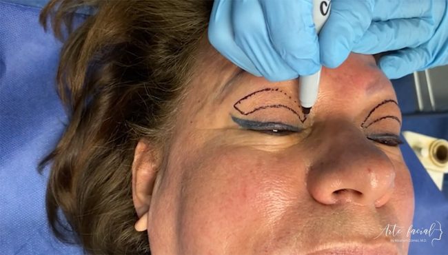 Blepharoplasty a surgery to lift droopy eyelids