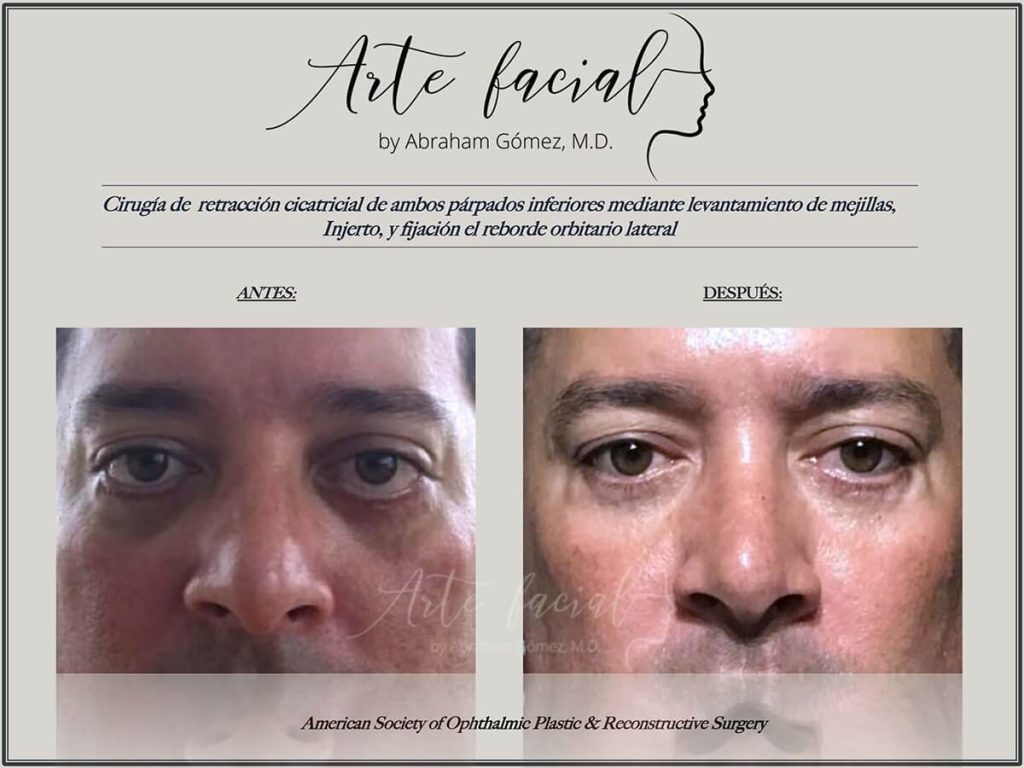 Skin shortage after blepharoplasty is the main cause of eyelid retraction