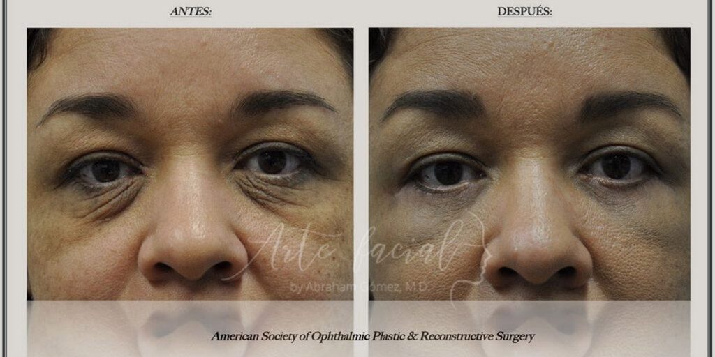 Fotos de antes y después de cirugía plástica de párpados