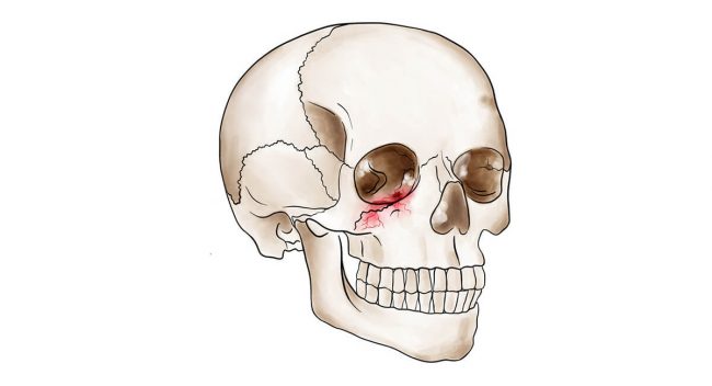 Repair of Orbital Fractures