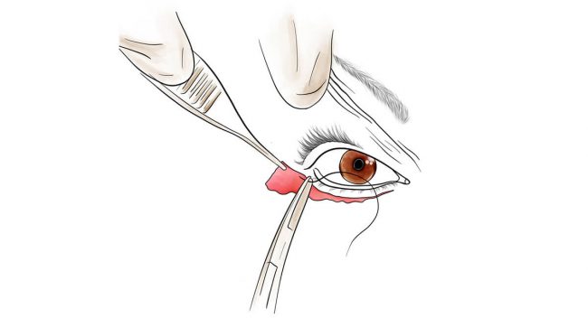 Tratamiento de Complicaciones de la Cirugía Estética de Párpados - Revisional surgery & treatment of eyelid retraction