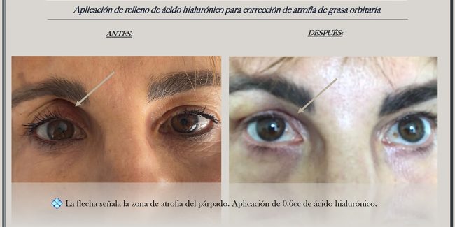 Tratamiento de cicatrices en el párpado después de cirugía para remover cáncer