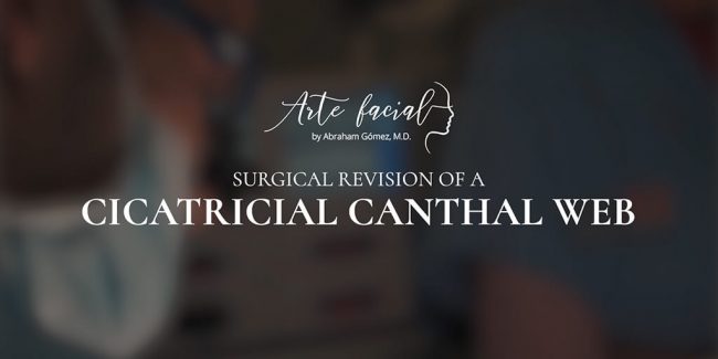 Surgical revision of a cicatricial canthal web