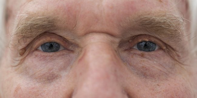 Cuál es el mejor tratamiento para los párpados caídos