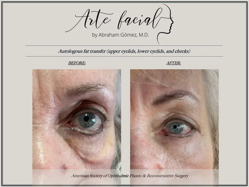 Before and after facial fat transfer