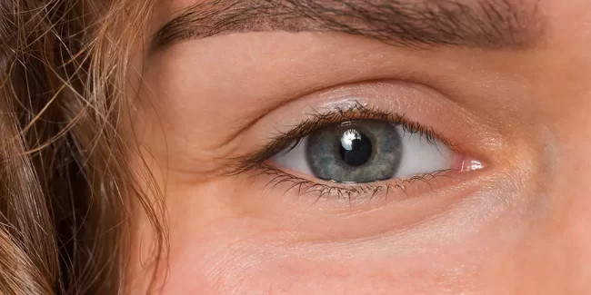 Cirugía para párpados hinchados