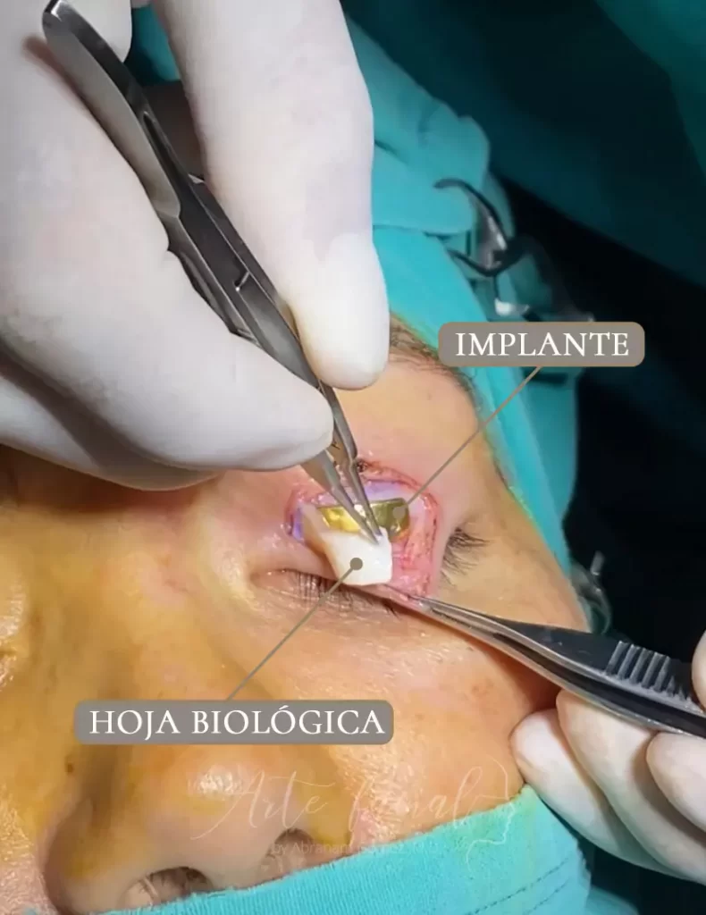 parálisis facial - pesa de oro