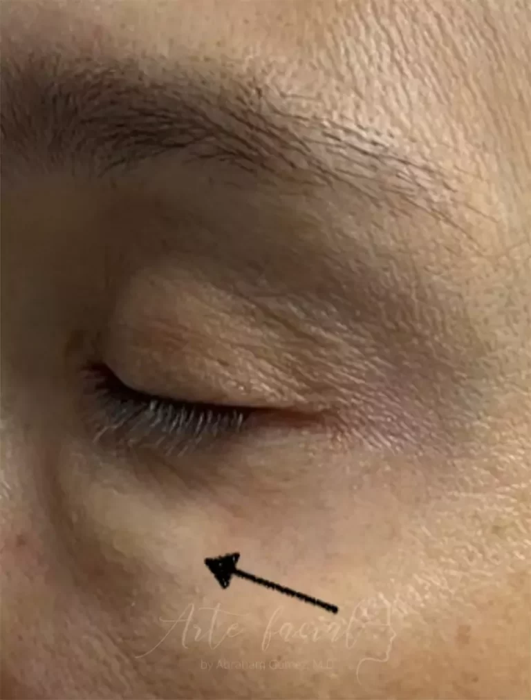 Acumulación de líquido en la región de los párpados y mejillas