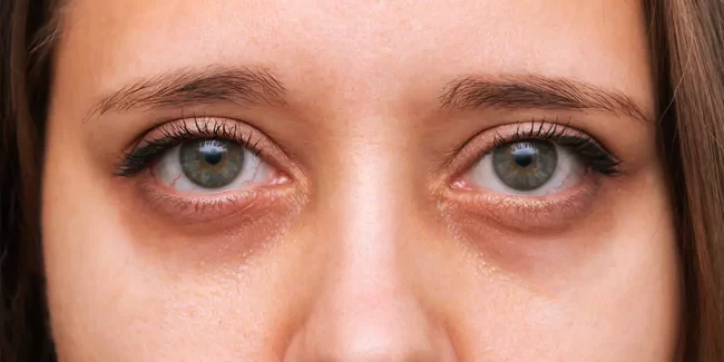 Fillers around the eyes