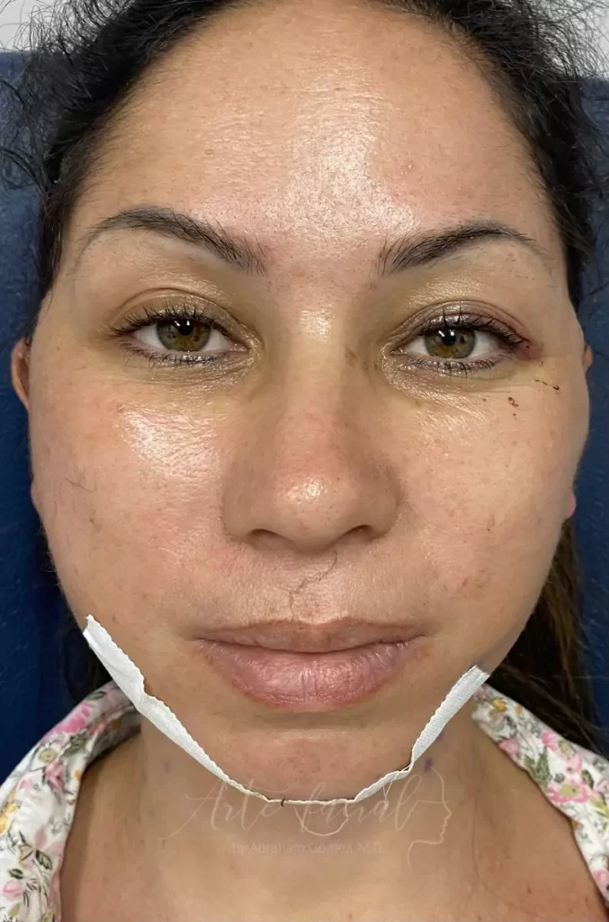 Mild bruising and moderate swelling on first postoperative day