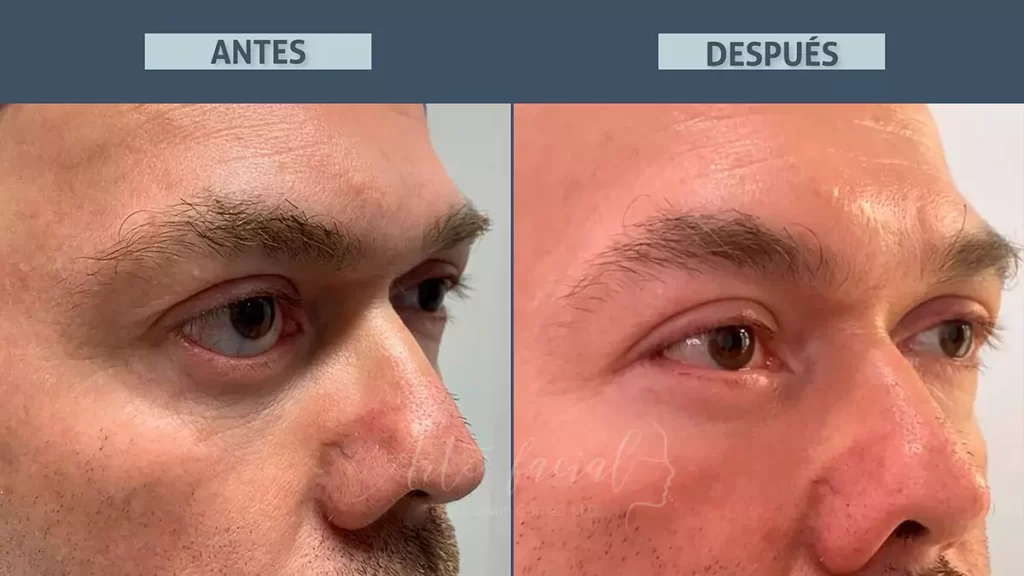 Recuperación después de la reparación de la retracción del párpado inferior