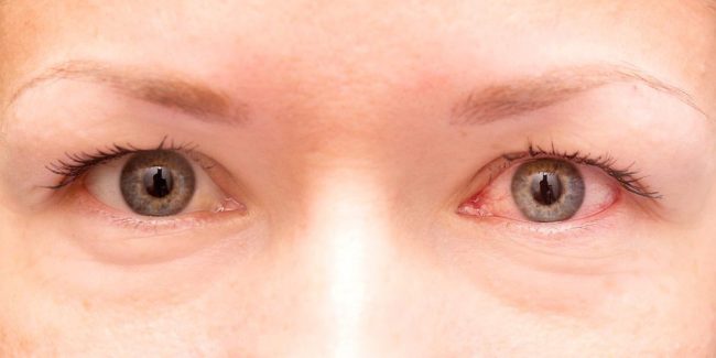 How to treat eyelid scarring after blepharoplasty