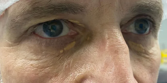 Tratamiento para los xantelasmas