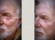 Retracción del párpado inferior después de una blefaroplastia