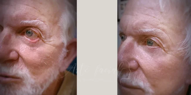 Post-blepharoplasty lower eyelid retraction