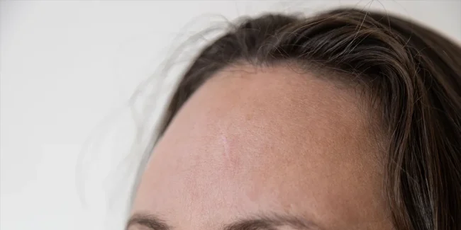 Treatment of frontal osteoma