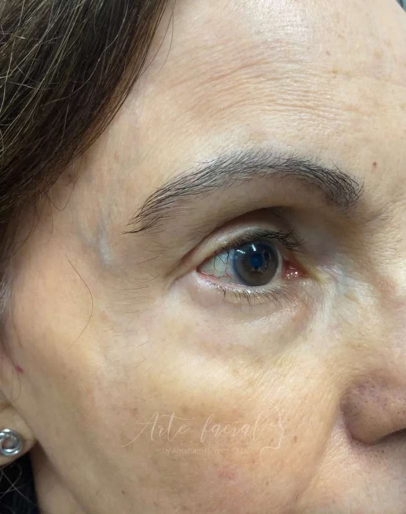 2 meses después de la operación