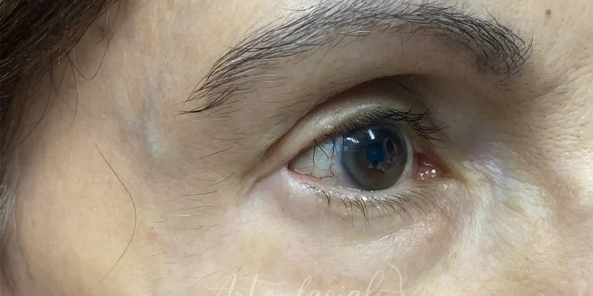 Eyelid reconstruction after Mohs surgery in Costa Rica
