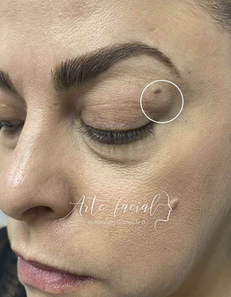 Abultamiento producido por la glándula