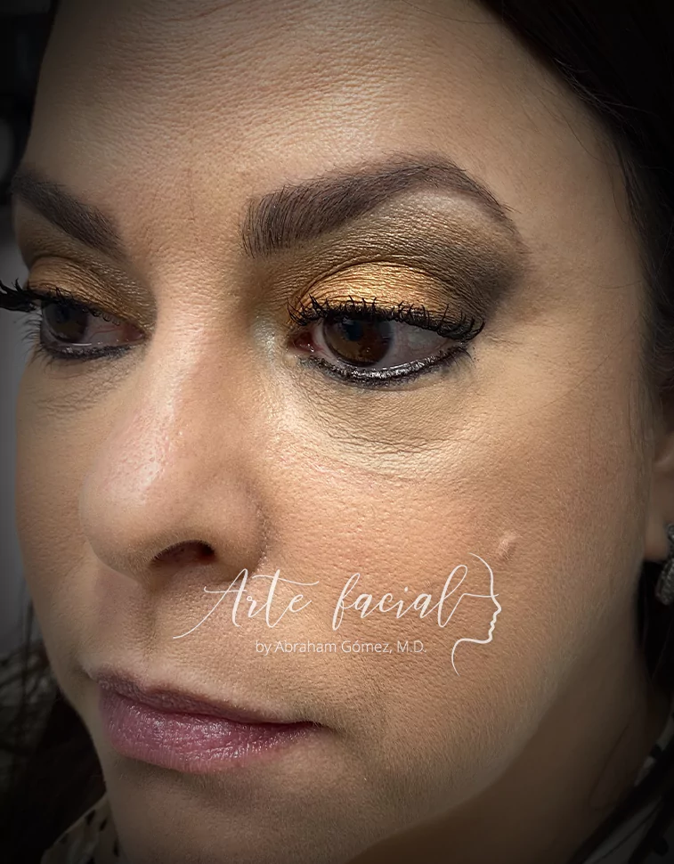 Dos meses después de la cirugía