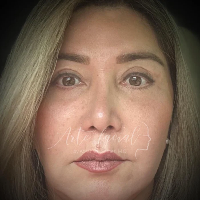 Tres meses después de la operación.