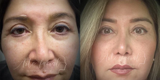 Striving for the best outcome in lower eyelid retraction surgery