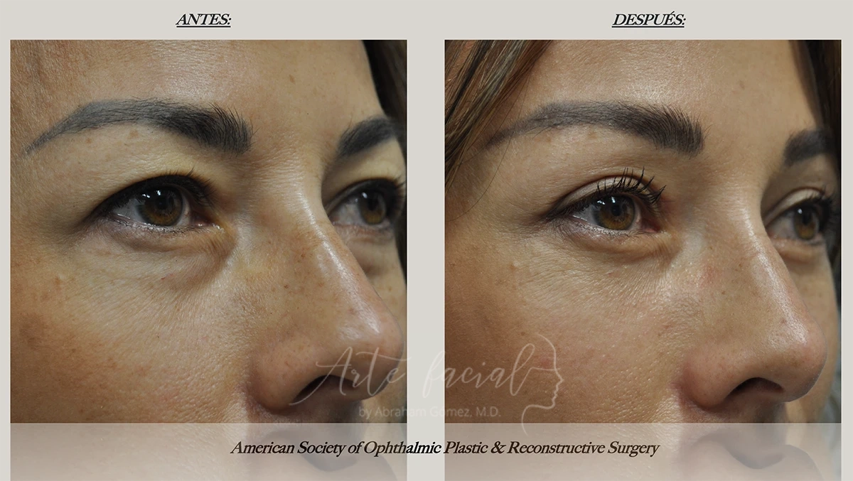 Elevación de cejas endoscópica