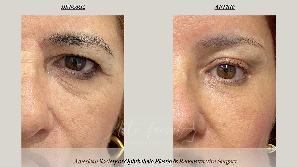 Elevación de cejas endoscópica